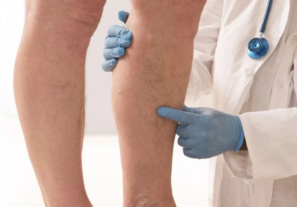 Doctor examining leg with varicose veins