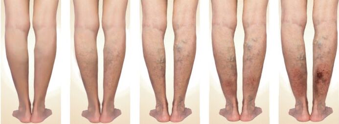 Stages of varicose veins development