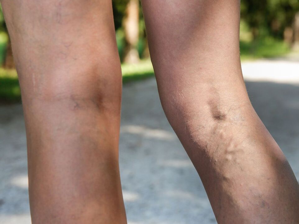 Varicose veins in the legs