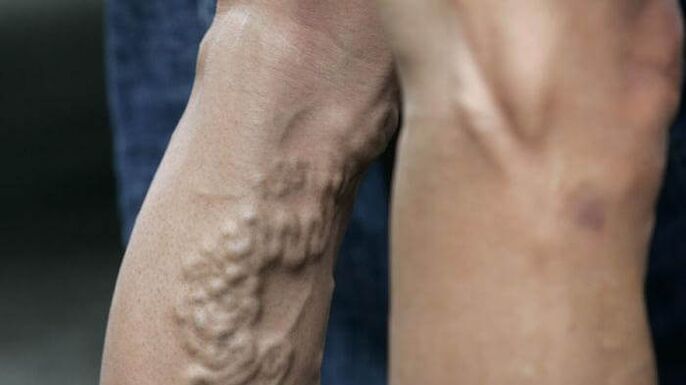 late varicose veins