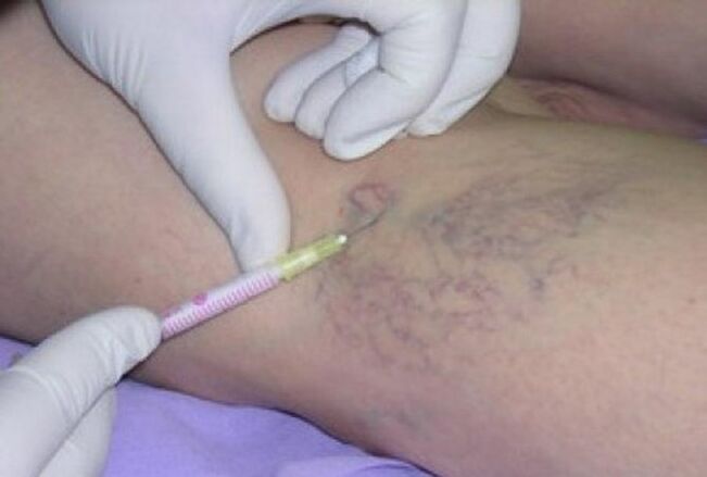 Varicose vein injection