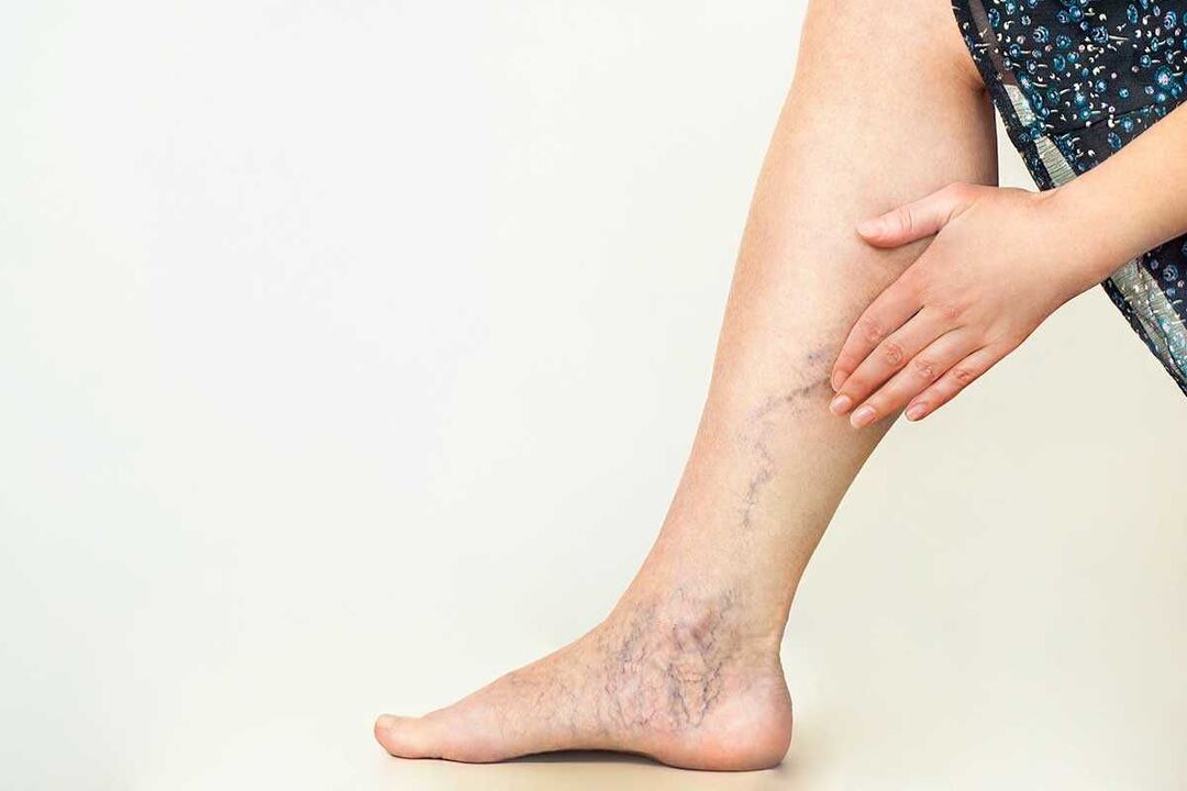 Symptoms of varicose veins