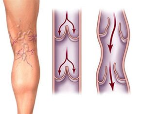 Normal operation of healthy venous valves and pathology of varicose valves