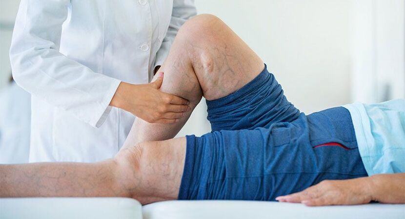 Late stage varicose veins