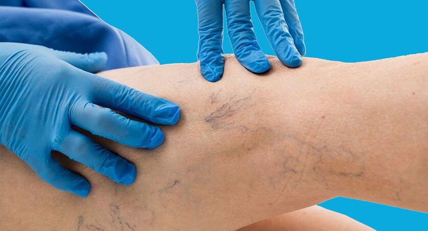 Symptoms of varicose veins