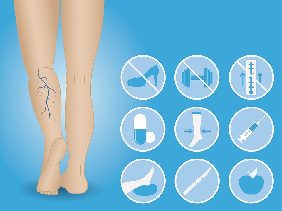 Varicose veins of lower limbs