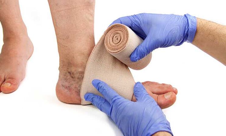 Treatment of varicose veins in the legs can be supplemented by the use of compression stockings