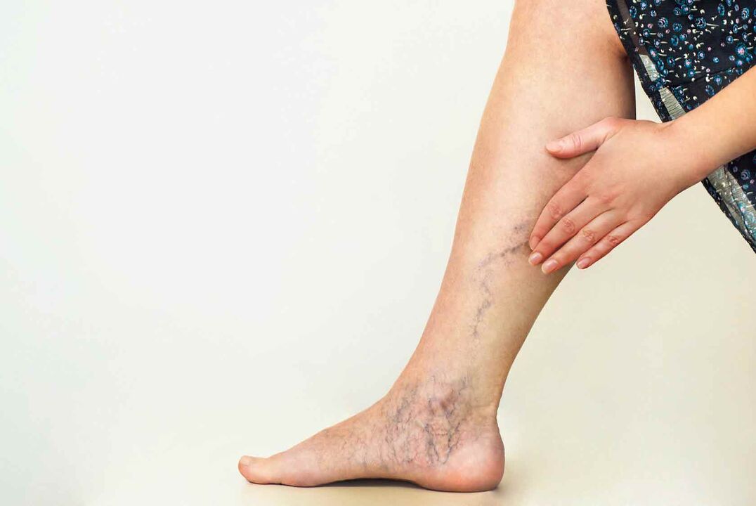 Varicose veins in female legs