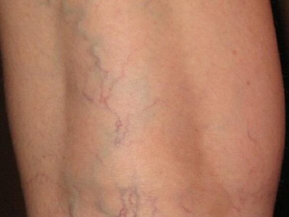 Types of varicose veins