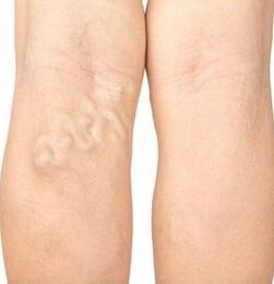 Symptoms of varicose veins