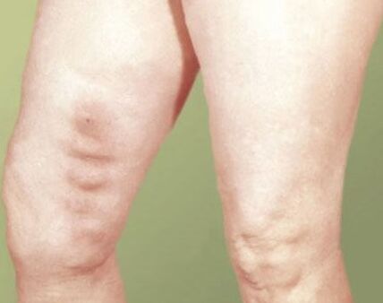 vein