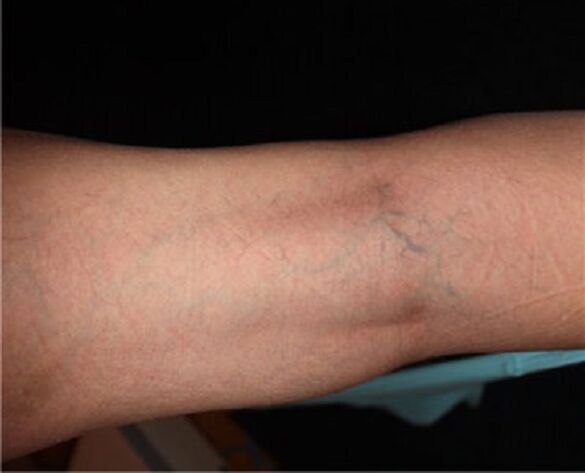 Symptoms of varicose veins