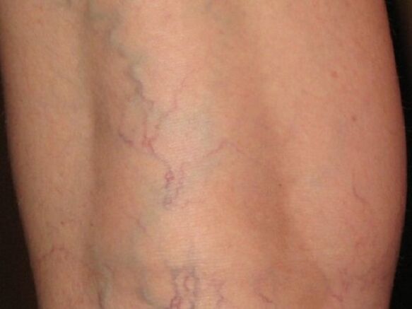The stage of varicose veins