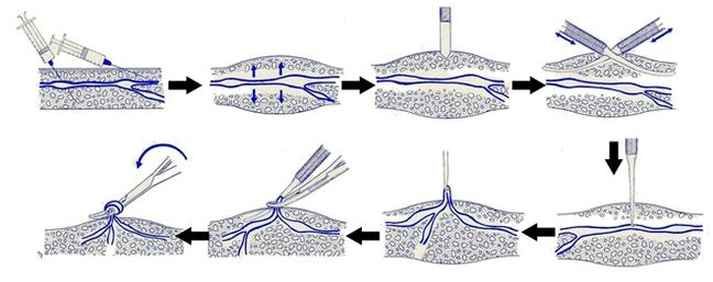 Varadi Operation