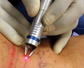 How to perform laser treatment for varicose veins