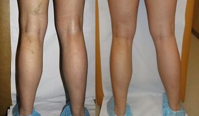 Laser processing of varicose veins before and after