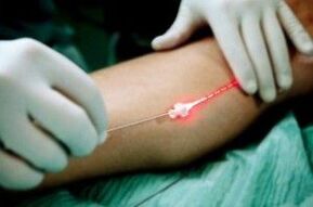 Laser treatment of varicose veins on the legs