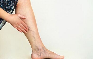 How to treat varicose veins of lower limbs