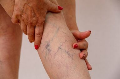 Varicose veins of lower limbs