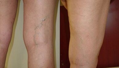 Microphlebectomy for the treatment of varicose veins