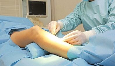 What symptoms warrant varicose vein surgery