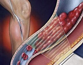 Deep varicose veins of lower limbs