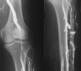 Diagnostic options for varicose veins in the extremities