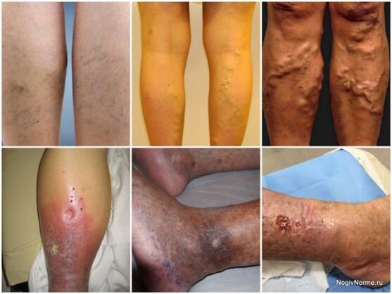 The degree of damage to veins