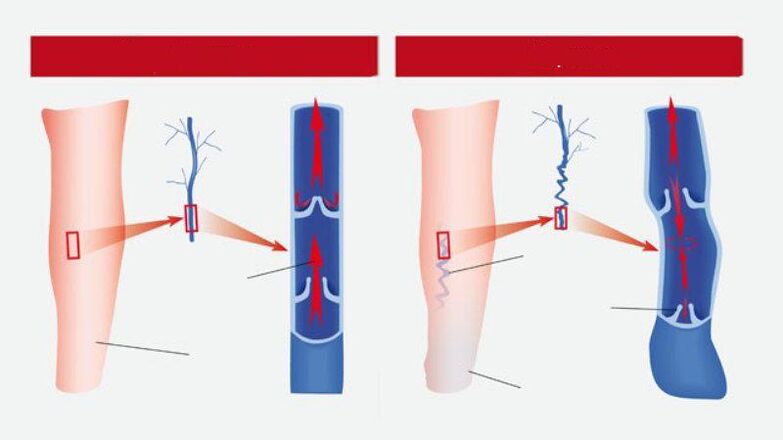 What is varicose veins like